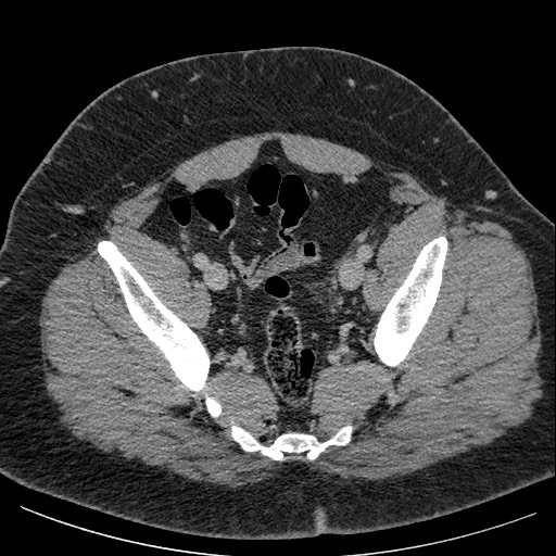 Burned-out testicular seminoma - retroperitoneal nodal metastases (Radiopaedia 62872-71245 A 62).jpg