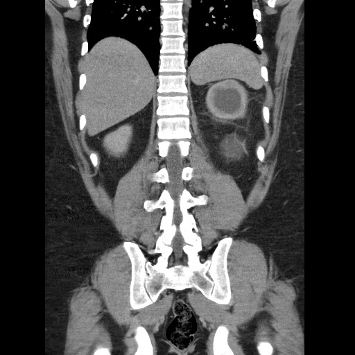Burned-out testicular seminoma - retroperitoneal nodal metastases (Radiopaedia 62872-71245 B 50).jpg