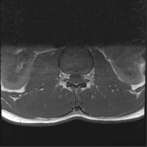 File:Burst fracture - T12 with conus compression (Radiopaedia 56825-63646 Axial T1 4).png
