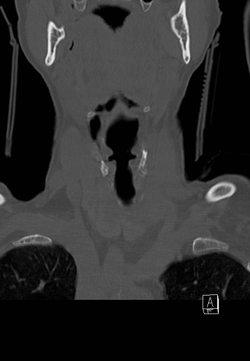 C1 and C2 (peg) fractures (Radiopaedia 36618-38184 Coronal bone window 3).jpg