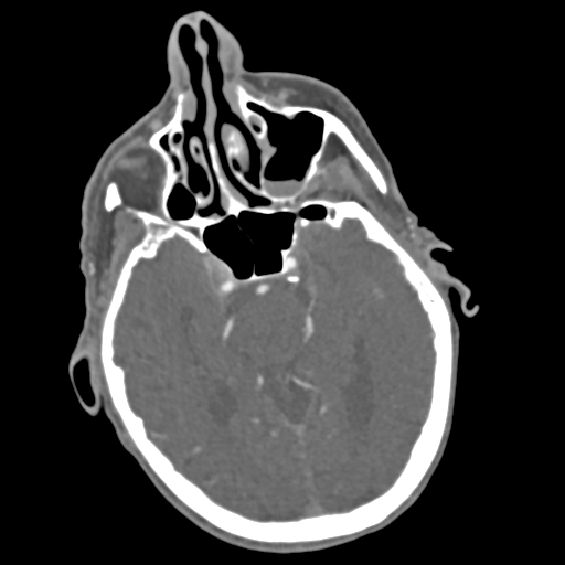 File:C2 fracture with vertebral artery dissection (Radiopaedia 37378-39200 A 227).png