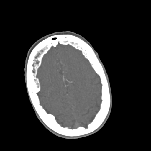 File:C2 fracture with vertebral artery dissection (Radiopaedia 37378-39200 A 285).png