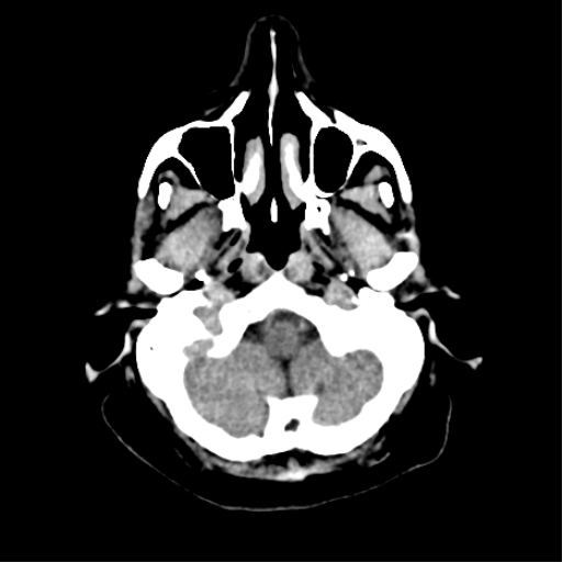 File:CNS Lymphoma (Radiopaedia 44198-47794 Axial non-contrast 6).png