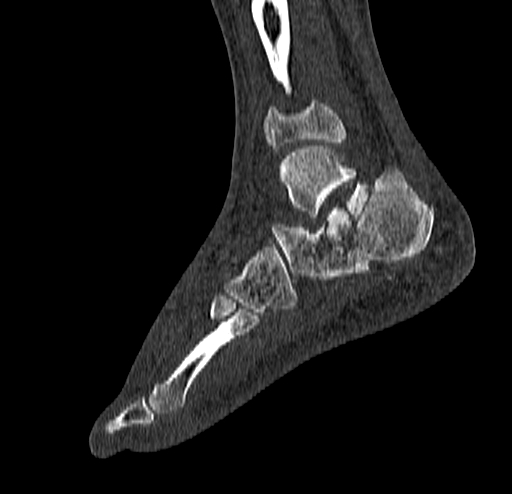 Calcaneal fracture - Sanders type 4 (Radiopaedia 90179-107370 Sagittal bone window 60).jpg