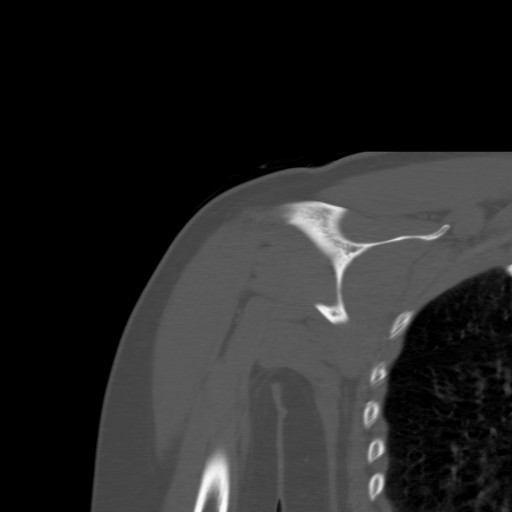 File:Calcific tendinitis of the infraspinatus tendon (Radiopaedia 87256-103539 Coronal bone window 37).jpg