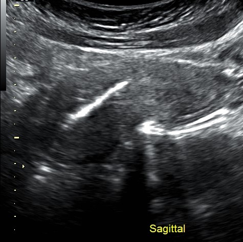 File:Calcifications associated with the intrauterine device (Radiopaedia 84291-99580 A 1).jpg