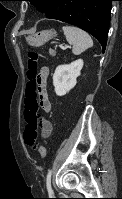 Calcified adrenal glands and Spigelian hernia (Radiopaedia 49741-54988 C 38).jpg