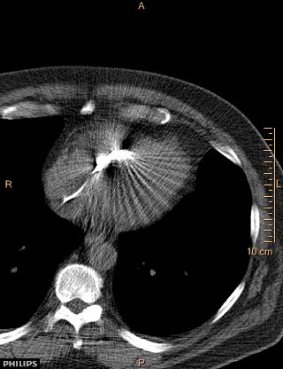 File:Calcified cardiac fibroma (Radiopaedia 39267-41519 Axial non-contrast 10).jpg