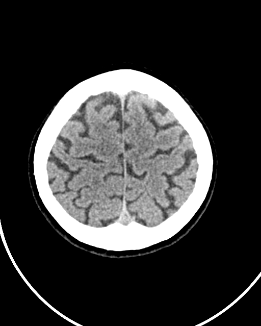 Calcified meningioma (Radiopaedia 74361-85243 Axial non-contrast 10).jpg