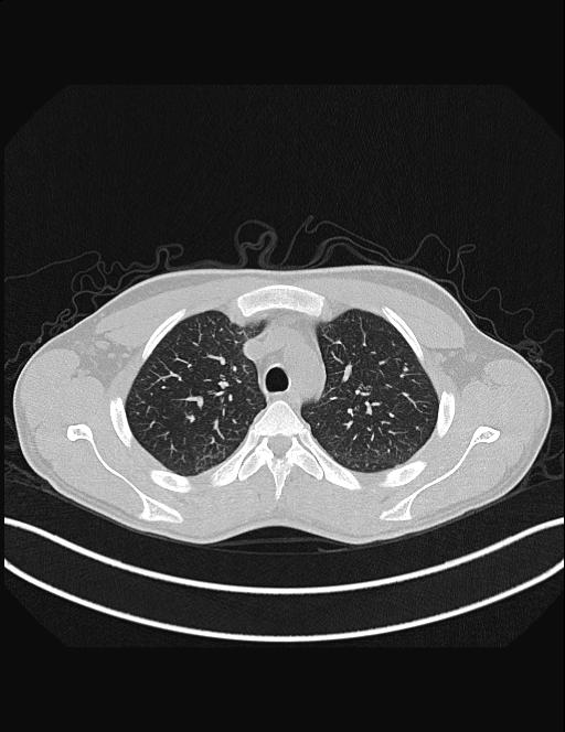 Calcifying pulmonary metastases (Radiopaedia 33359-34396 Axial lung window 16).jpg