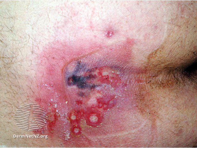 File:Calciphylaxis can lead to- (DermNet NZ systemic-calciphylaxis5).jpg