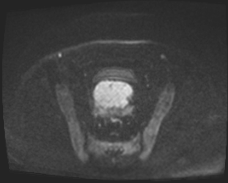 Cancer cervix - stage IIb (Radiopaedia 75411-86615 Axial DWI 75).jpg