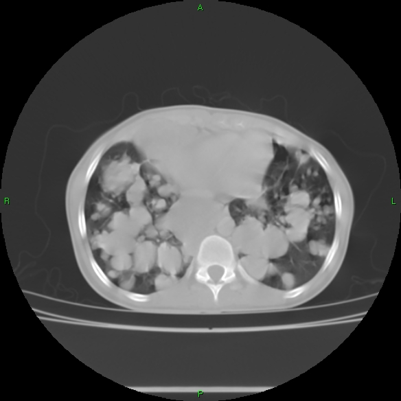 File:Cannon ball metastases - synovial sarcoma (Radiopaedia 26135-26271 Axial lung window 27).jpg