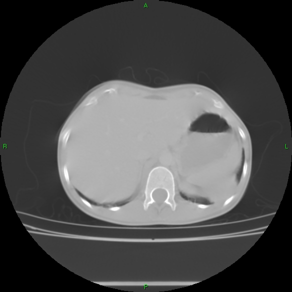 File:Cannon ball metastases - synovial sarcoma (Radiopaedia 26135-26271 Axial lung window 35).jpg