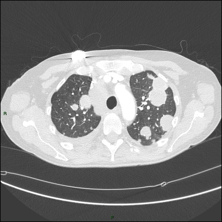 Cannonball metastases (Radiopaedia 82110-96150 Axial lung window 58).jpg