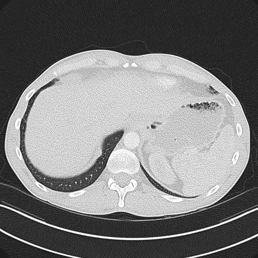 Cannonball metastases - testicular choriocarcinoma (Radiopaedia 84510-99891 Axial lung window 84).jpg