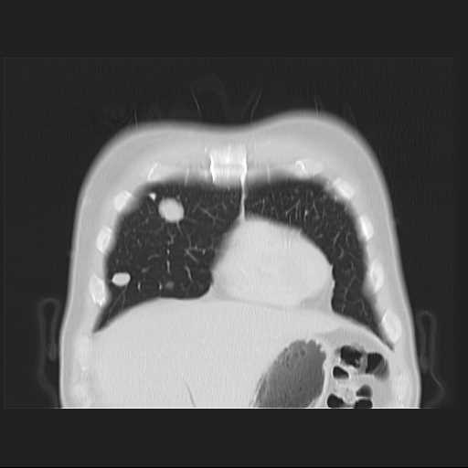 File:Cannonball pulmonary metastases (Radiopaedia 67684-77101 C 3).jpg