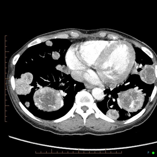 File:Canonball lung metastasis (Radiopaedia 77634-89837 B 73).jpg