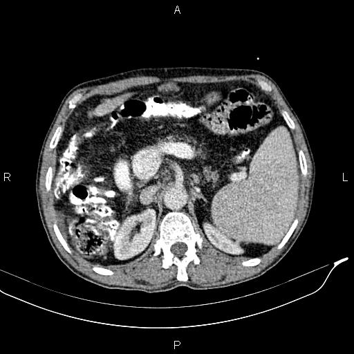 Caput medusae sign - portal hypertension (Radiopaedia 64007-72759 A 27).jpg