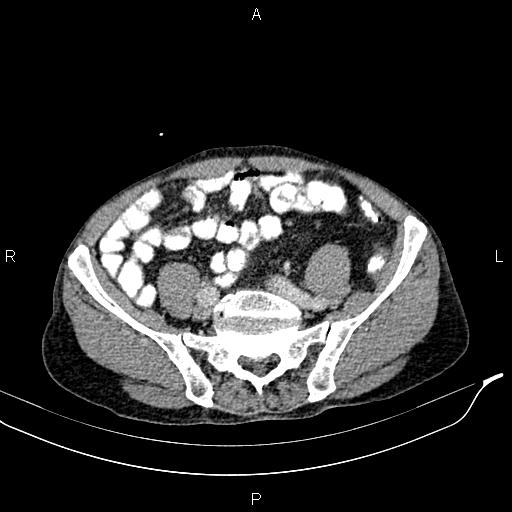Caput medusae sign - portal hypertension (Radiopaedia 64007-72759 A 72).jpg