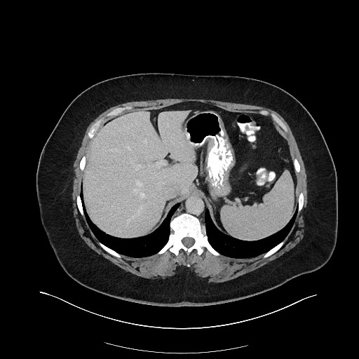 Carcinoid tumor - terminal ileum (Radiopaedia 60931-68739 A 29).jpg