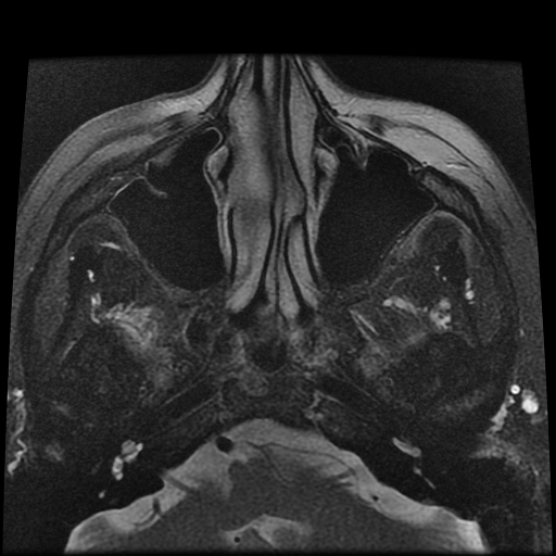 File:Carcinoid tumor of the ileum with metastasis to orbit (Radiopaedia 28165-28424 Axial T2 3).jpg
