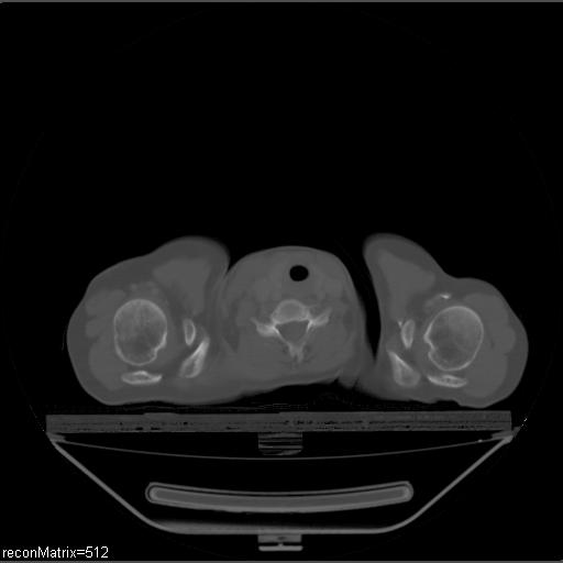 File:Carcinoma of esophagus (Radiopaedia 27356-27550 Axial bone window 34).jpg