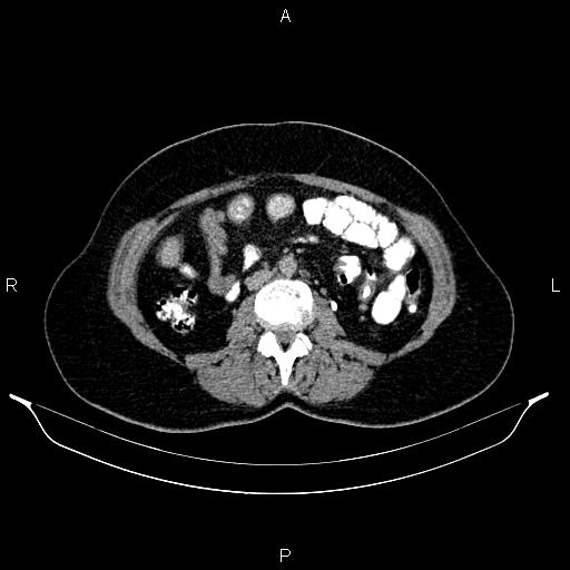File:Carcinoma of uterine cervix (Radiopaedia 85861-101700 Axial C+ delayed 38).jpg