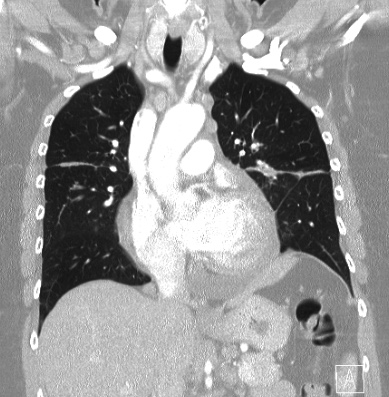 File:Cardiac sarcoidosis (Radiopaedia 74548-85534 Coronal lung window 29).jpg