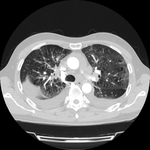 Cardiac tamponade (Radiopaedia 78607-91368 Axial lung window 27).jpg