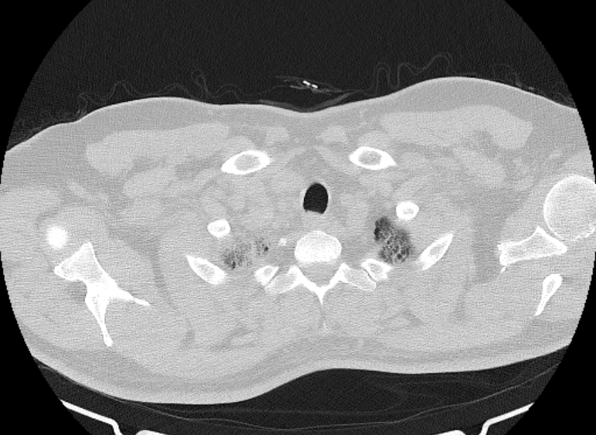 Cardiogenic pulmonary edema (Radiopaedia 68180-77678 Axial lung window 1).jpg