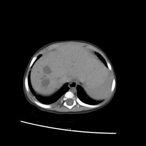 File:Caroli disease with autosomal recessive polycystic kidney disease (ARPKD) (Radiopaedia 89651-106703 Axial non-contrast 6).jpg