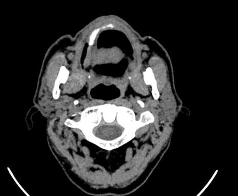 Carotid body tumor (Radiopaedia 61750-69757 Axial non-contrast 14).jpg