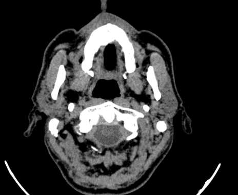 File:Carotid body tumor (Radiopaedia 61750-69757 Axial non-contrast 9).jpg