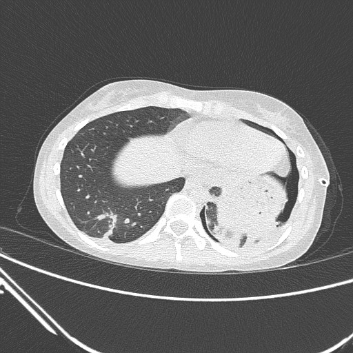 Catamenial pneumothorax (Radiopaedia 27946-28197 lung window 125).jpg