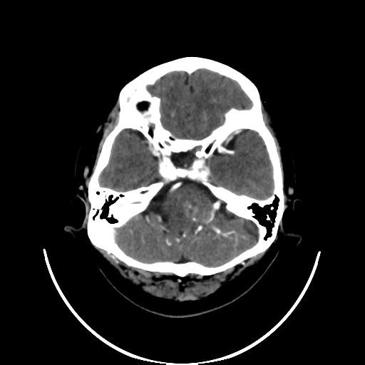 File:Cavernoma with developmental venous anomaly (Radiopaedia 22470-22506 C+ arterial phase 8).jpg