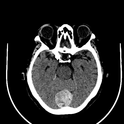 File:Cavernous hemangioma of the cerebellar falx (Radiopaedia 73025-83723 Axial non-contrast 50).jpg