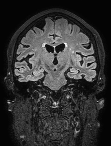 Cavernous hemangioma of the cerebellar falx (Radiopaedia 73025-83724 Coronal FLAIR 182).jpg