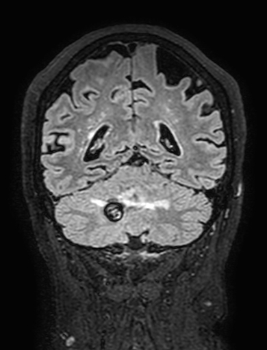 Cavernous hemangioma of the cerebellar falx (Radiopaedia 73025-83724 Coronal FLAIR 254).jpg