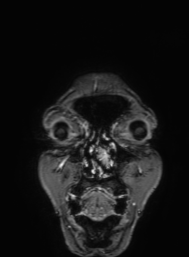 Cavernous hemangioma of the cerebellar falx (Radiopaedia 73025-83724 Coronal T1 C+ 16).jpg
