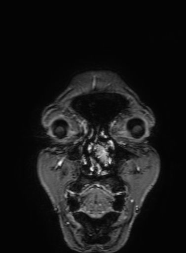 Cavernous hemangioma of the cerebellar falx (Radiopaedia 73025-83724 Coronal T1 C+ 17).jpg