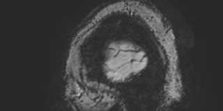 Cavernous hemangioma of the cerebellar falx (Radiopaedia 73025-83724 Sagittal BOLD 7).jpg