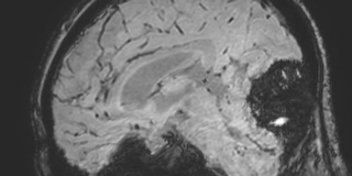 Cavernous hemangioma of the cerebellar falx (Radiopaedia 73025-83724 Sagittal BOLD 97).jpg