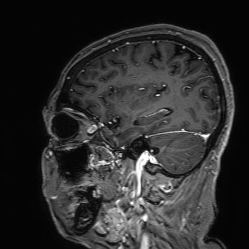 File:Cavernous hemangioma of the cerebellar falx (Radiopaedia 73025-83724 Sagittal T1 C+ 58).jpg