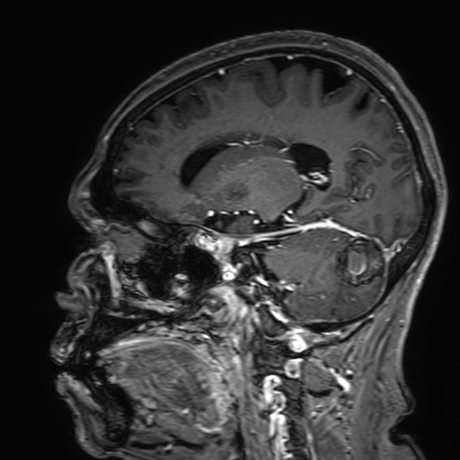 Cavernous hemangioma of the cerebellar falx (Radiopaedia 73025-83724 Sagittal T1 C+ 82).jpg