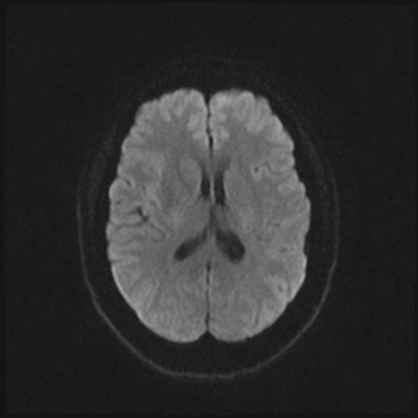 Cavernous sinus meningioma (Radiopaedia 63682-72367 DWI 54).jpg