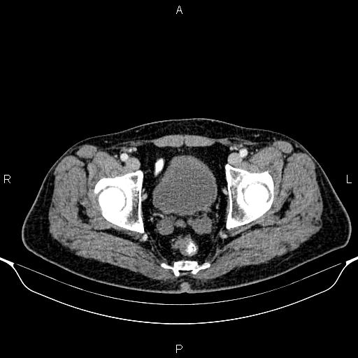 Cecal adenocarcinoma (Radiopaedia 85324-100916 B 92).jpg