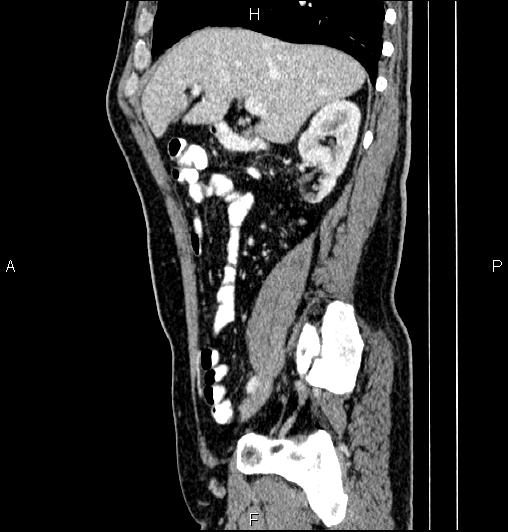 Cecal adenocarcinoma (Radiopaedia 85324-100916 E 29).jpg