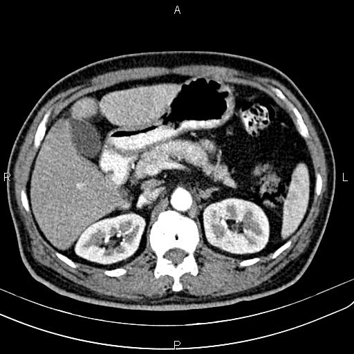Cecal cancer with appendiceal mucocele (Radiopaedia 91080-108651 A 73).jpg