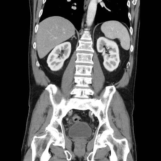 Cecal mass causing appendicitis (Radiopaedia 59207-66531 B 35).jpg